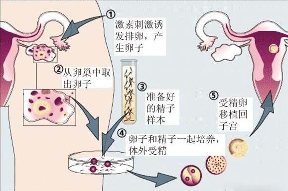 借卵试管代怀选性别_借卵试管代怀选性别:选择生育性别的新方式