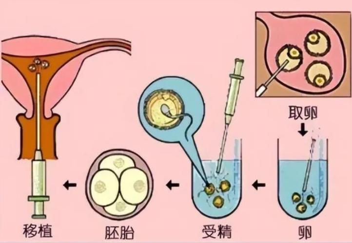 中国可以借卵试管婴儿(中国试管婴儿：借卵新选择)